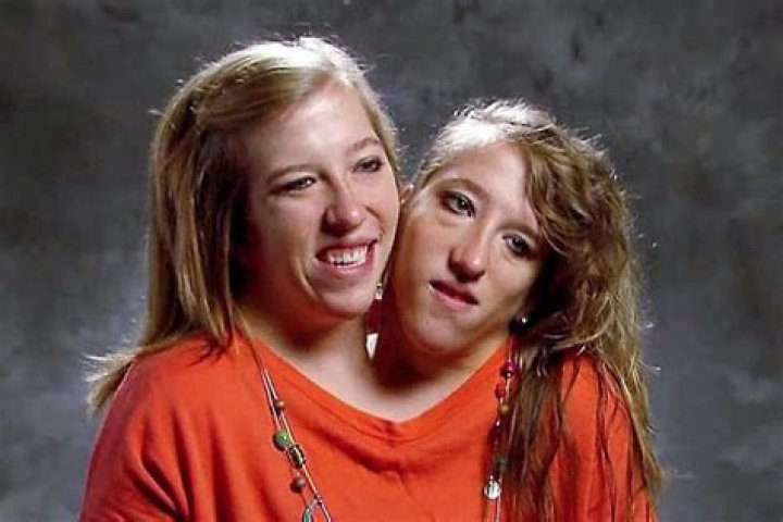 Abby and Brittany Hensel Cause of Death: A Comprehensive Look Into Their Lives and Legacy