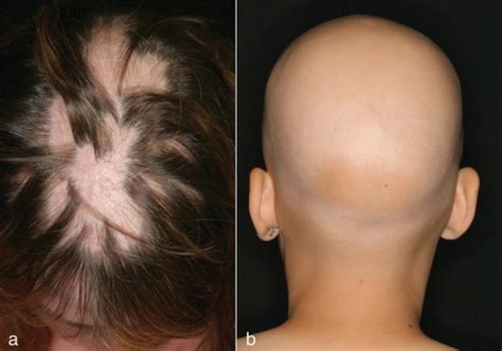 Cynthia Erivo and Her Battle with Alopecia Areata: A Comprehensive Insight