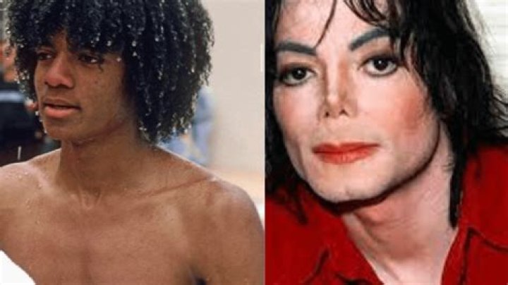 Michael Jackson Disease: Understanding the Medical Conditions That Shaped His Legacy
