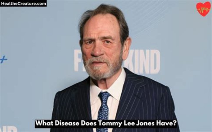 What Disease Does Tommy Lee Jones Have? A Comprehensive Look at His Health and Legacy